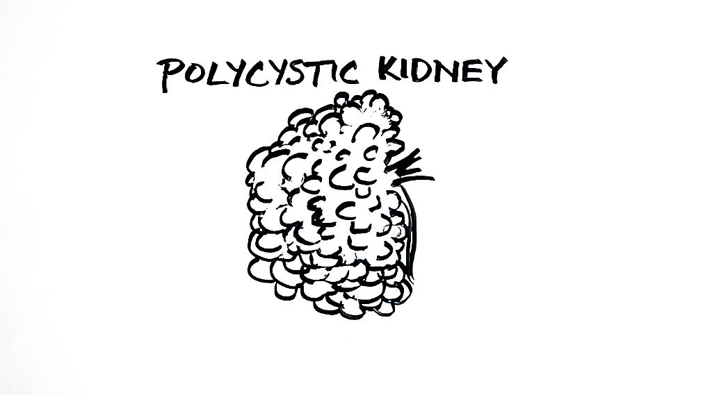 Normal Kidney vs. Polycystic Kidney
